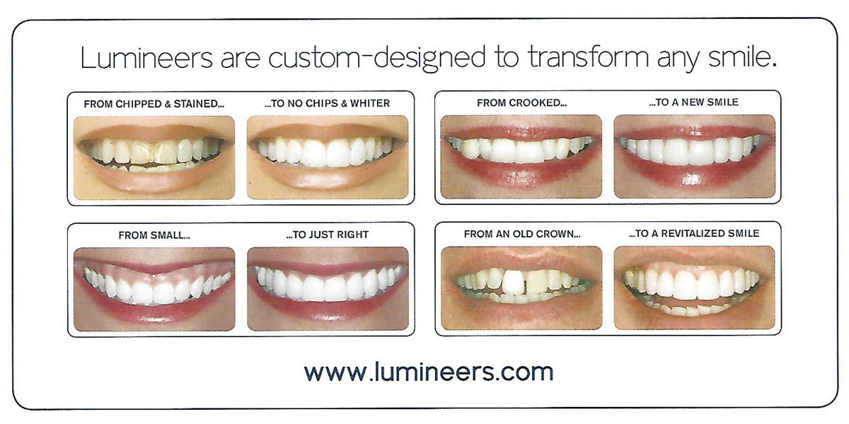 Closeup of Porcelain Veneers